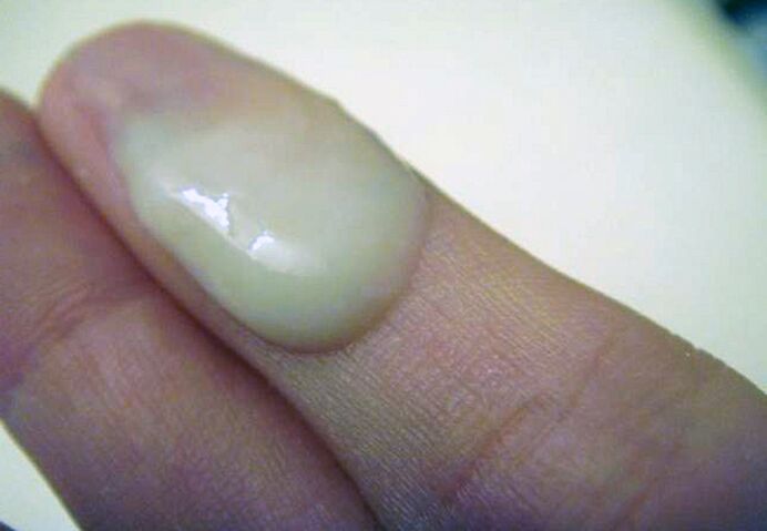 Patoloogiline eritis STD juures